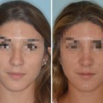 Rhinoplasty Before and After Photos in Miami, FL, Patient 596