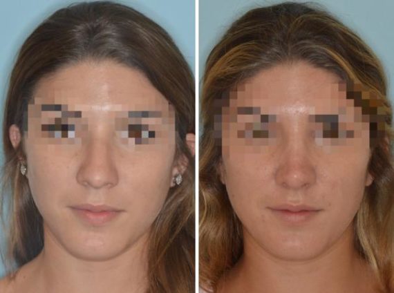 Rhinoplasty Before and After Photos in Miami, FL, Patient 596