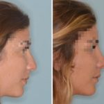 Rhinoplasty Before and After Photos in Miami, FL, Patient 596