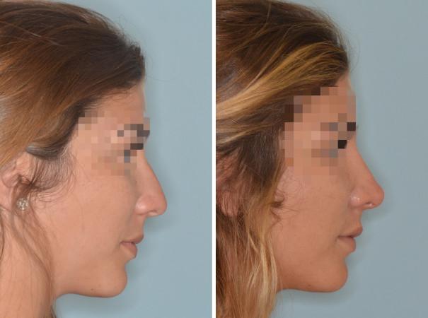 Rhinoplasty Before and After Photos in Miami, FL, Patient 596