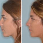 Rhinoplasty Before and After Photos in Miami, FL, Patient 596