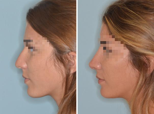 Rhinoplasty Before and After Photos in Miami, FL, Patient 596