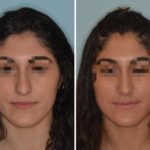 Rhinoplasty Before and After Photos in Miami, FL, Patient 606