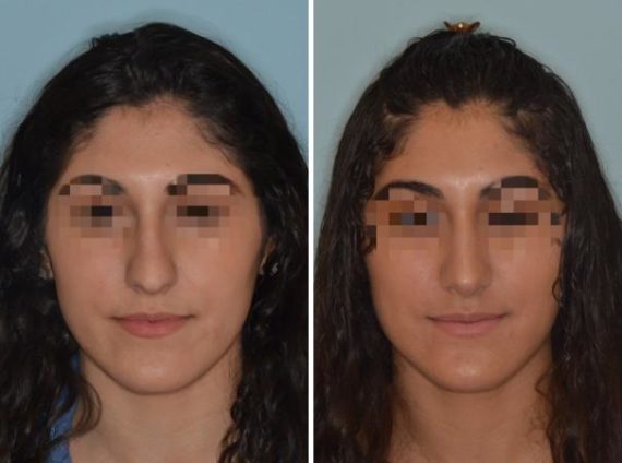 Rhinoplasty Before and After Photos in Miami, FL, Patient 606