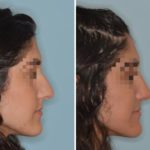 Rhinoplasty Before and After Photos in Miami, FL, Patient 606