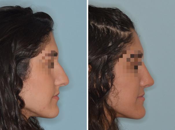 Rhinoplasty Before and After Photos in Miami, FL, Patient 606