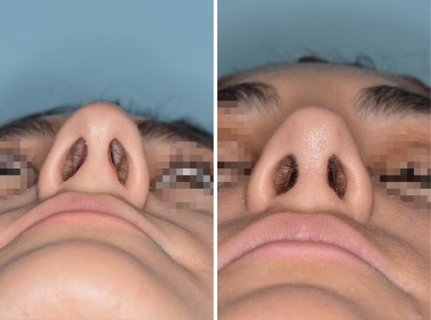 Rhinoplasty Before and After Photos in Miami, FL, Patient 606