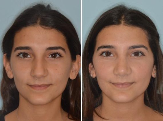 Rhinoplasty Before and After Photos in Miami, FL, Patient 616