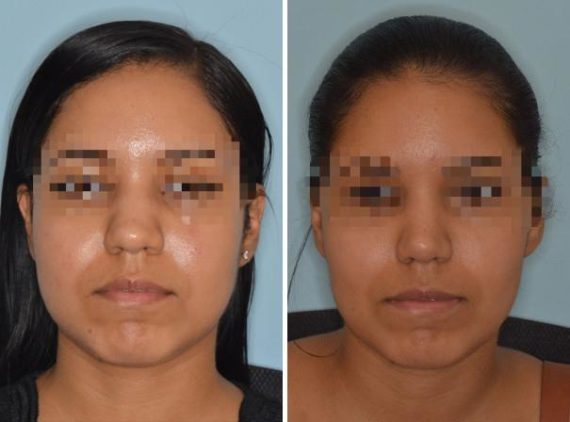 Rhinoplasty Before and After Photos in Miami, FL, Patient 623