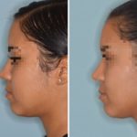 Rhinoplasty Before and After Photos in Miami, FL, Patient 623