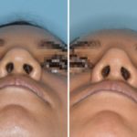 Rhinoplasty Before and After Photos in Miami, FL, Patient 623