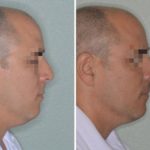 Rhinoplasty Before and After Photos in Miami, FL, Patient 646