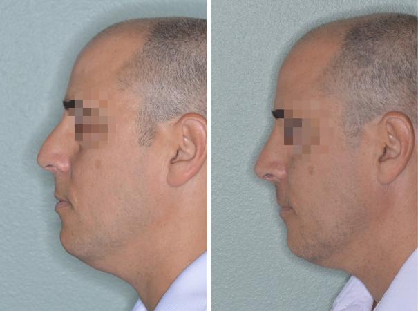 Rhinoplasty Before and After Photos in Miami, FL, Patient 646