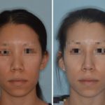 Rhinoplasty Before and After Photos in Miami, FL, Patient 656