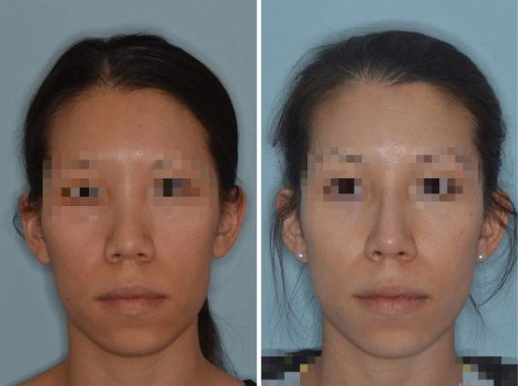 Rhinoplasty Before and After Photos in Miami, FL, Patient 656