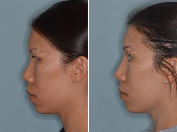 Rhinoplasty Before and After Photos in Miami, FL, Patient 656