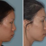 Rhinoplasty Before and After Photos in Miami, FL, Patient 656