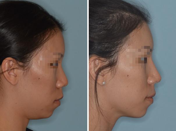 Rhinoplasty Before and After Photos in Miami, FL, Patient 656