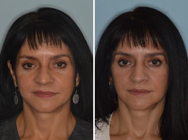 Rhinoplasty Before and After Photos in Miami, FL, Patient 666