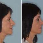 Rhinoplasty Before and After Photos in Miami, FL, Patient 666