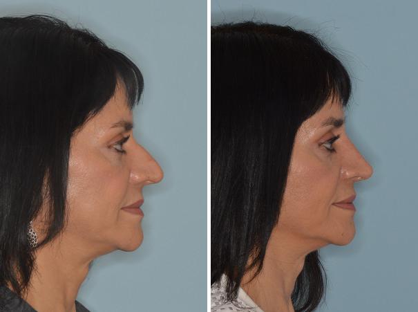 Rhinoplasty Before and After Photos in Miami, FL, Patient 666