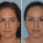 Rhinoplasty Before and After Photos in Miami, FL, Patient 679