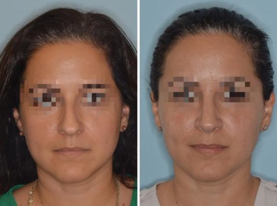 Rhinoplasty Before and After Photos in Miami, FL, Patient 679