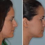Rhinoplasty Before and After Photos in Miami, FL, Patient 679
