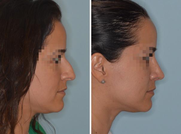 Rhinoplasty Before and After Photos in Miami, FL, Patient 679