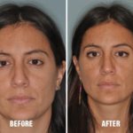 Rhinoplasty Before and After Photos in Miami, FL, Patient 226