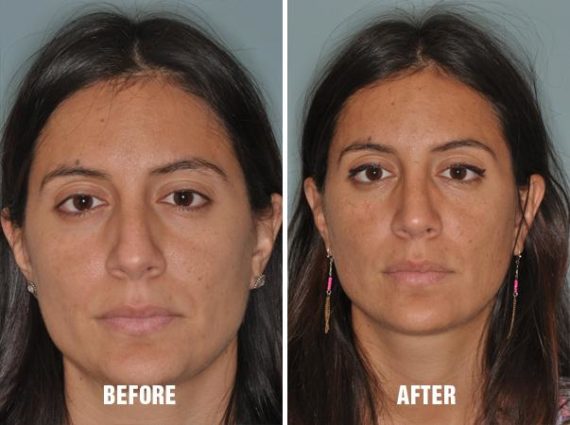 Rhinoplasty Before and After Photos in Miami, FL, Patient 226