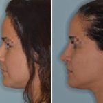 Rhinoplasty Before and After Photos in Miami, FL, Patient 679
