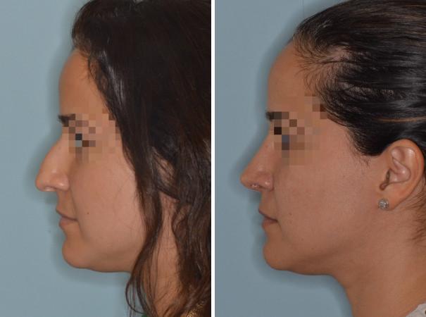 Rhinoplasty Before and After Photos in Miami, FL, Patient 679