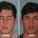 Rhinoplasty Before and After Photos in Miami, FL, Patient 174