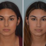 Rhinoplasty Before and After Photos in Miami, FL, Patient 683