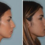 Rhinoplasty Before and After Photos in Miami, FL, Patient 683