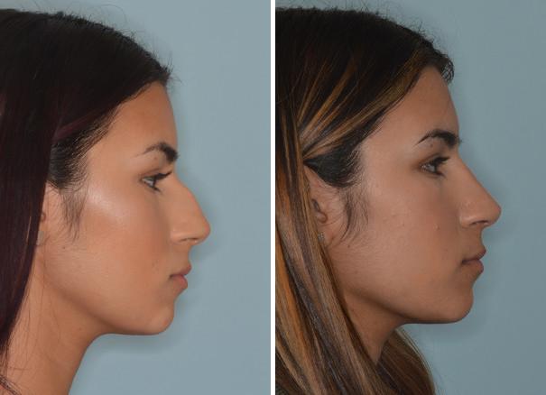 Rhinoplasty Before and After Photos in Miami, FL, Patient 683