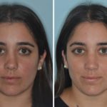 Rhinoplasty Before and After Photos in Miami, FL, Patient 690