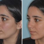 Rhinoplasty Before and After Photos in Miami, FL, Patient 690