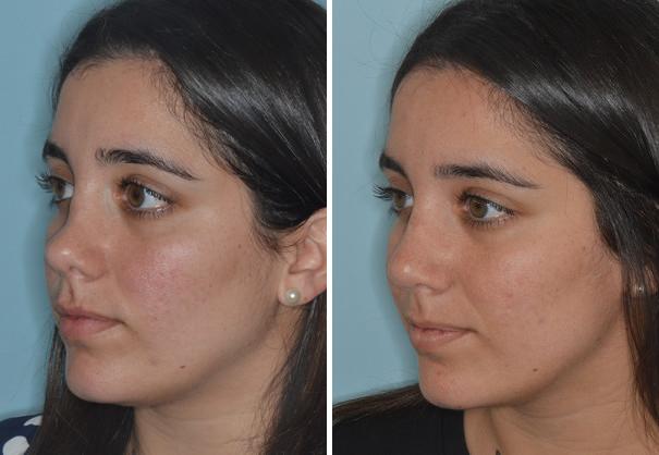 Rhinoplasty Before and After Photos in Miami, FL, Patient 690