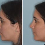 Rhinoplasty Before and After Photos in Miami, FL, Patient 690