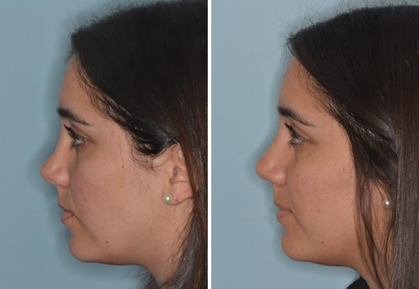 Rhinoplasty Before and After Photos in Miami, FL, Patient 690