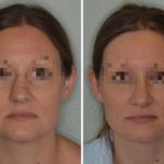 Rhinoplasty Before and After Photos in Miami, FL, Patient 700