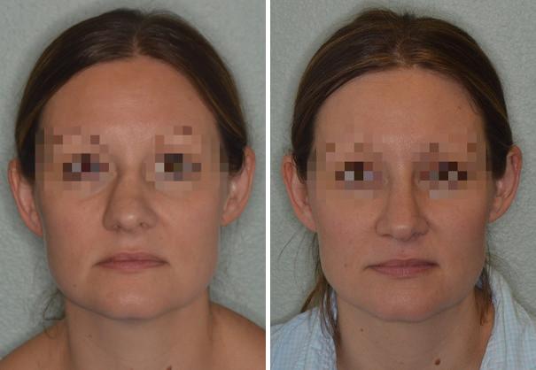 Rhinoplasty Before and After Photos in Miami, FL, Patient 700