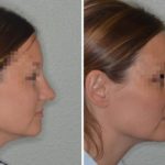 Rhinoplasty Before and After Photos in Miami, FL, Patient 700