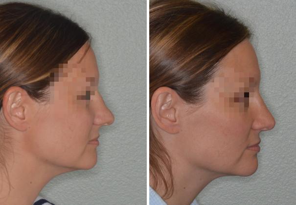 Rhinoplasty Before and After Photos in Miami, FL, Patient 700