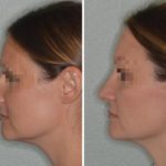 Rhinoplasty Before and After Photos in Miami, FL, Patient 700