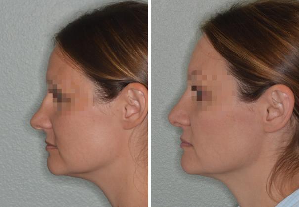 Rhinoplasty Before and After Photos in Miami, FL, Patient 700