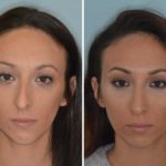 Rhinoplasty Before and After Photos in Miami, FL, Patient 714