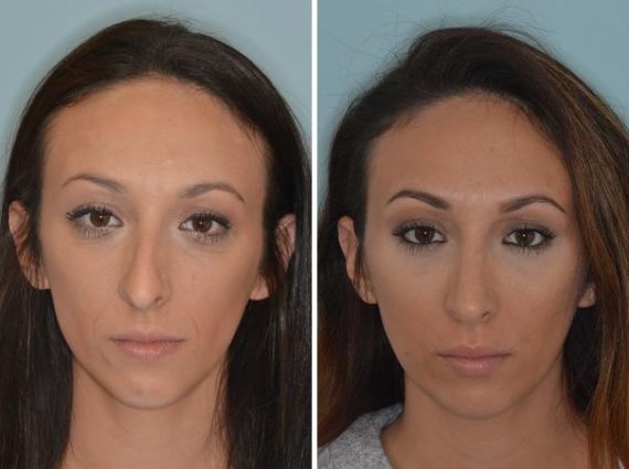 Rhinoplasty Before and After Photos in Miami, FL, Patient 714